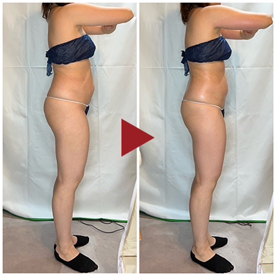 痩身 Before - After