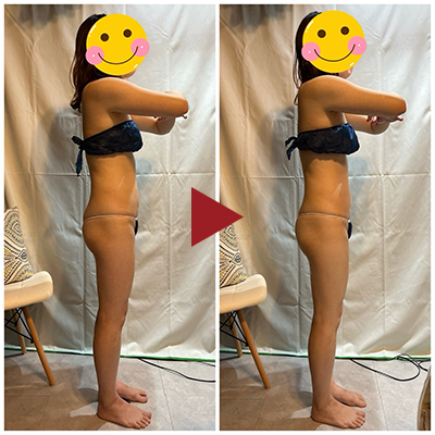 痩身 Before - After