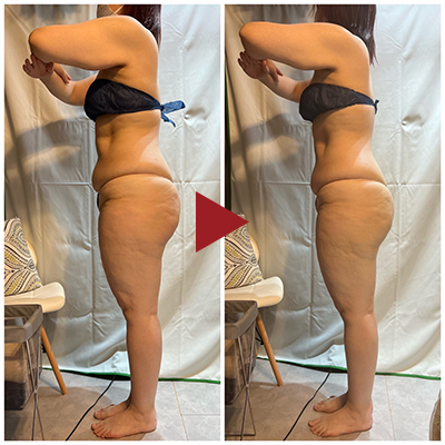 痩身 Before - After