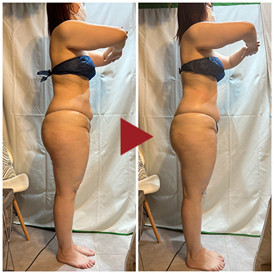 痩身 Before - After
